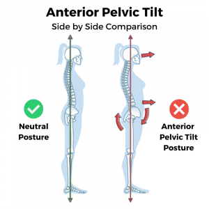 Anterior pelvic tilt side by side