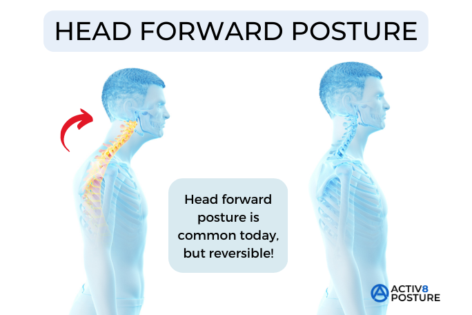 head forward posture is fixable
