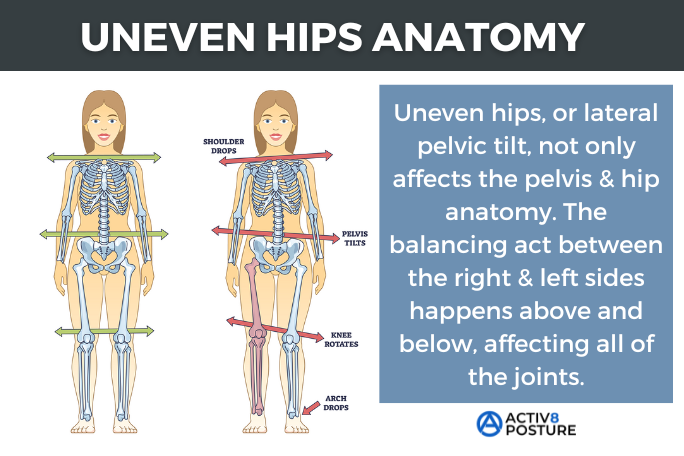 Illustration of the pelvis with one hip sitting higher than the other