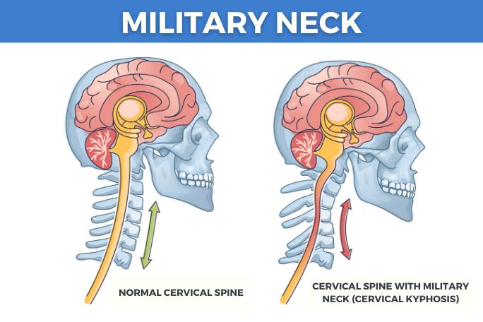Side-view illustration comparing a straightened military neck with a normal neck curve