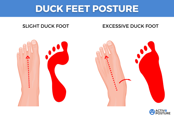 Illustration of common causes of duck feet posture, including hip rotation and foot position
