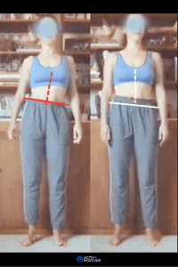 scoliosis before and after