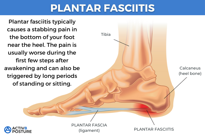 symptoms of plantar fasciitis