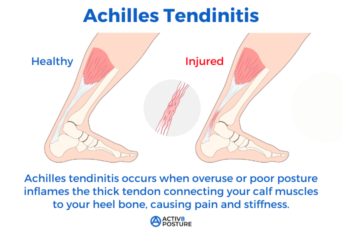 achilles tendinitis anatomy