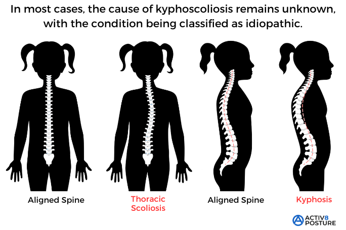 Illustration of common causes of kyphoscoliosis