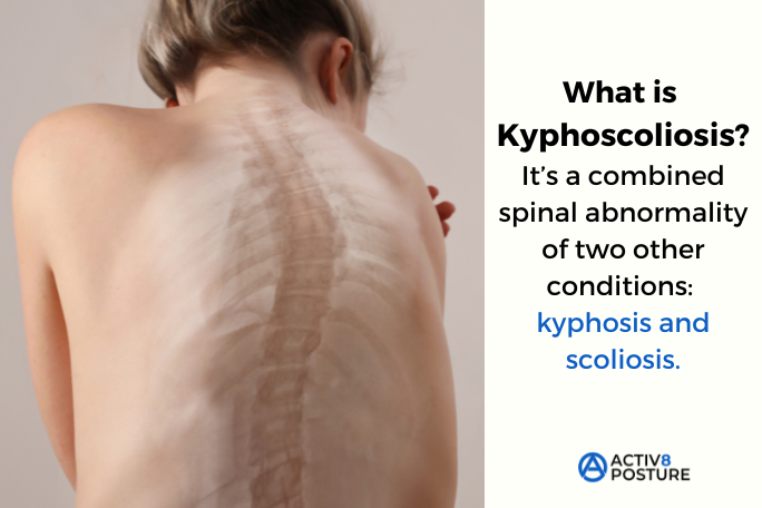 Illustration of kyphoscoliosis with the spine curving forward and to the side