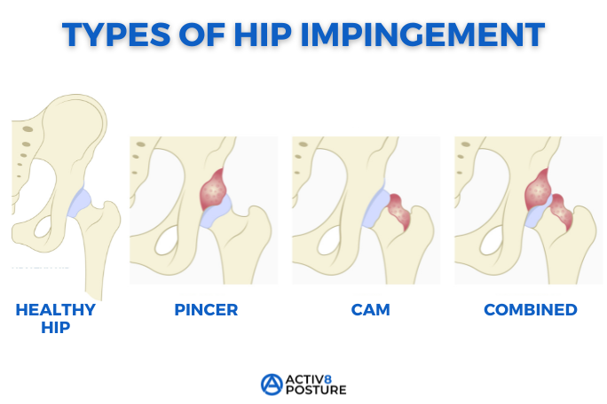 types of hip impingement