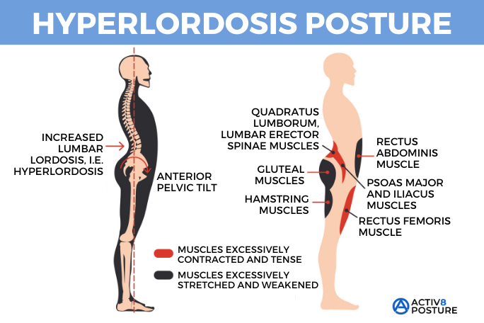 Illustration explaining hyperlordosis as an exaggerated lower-back curve